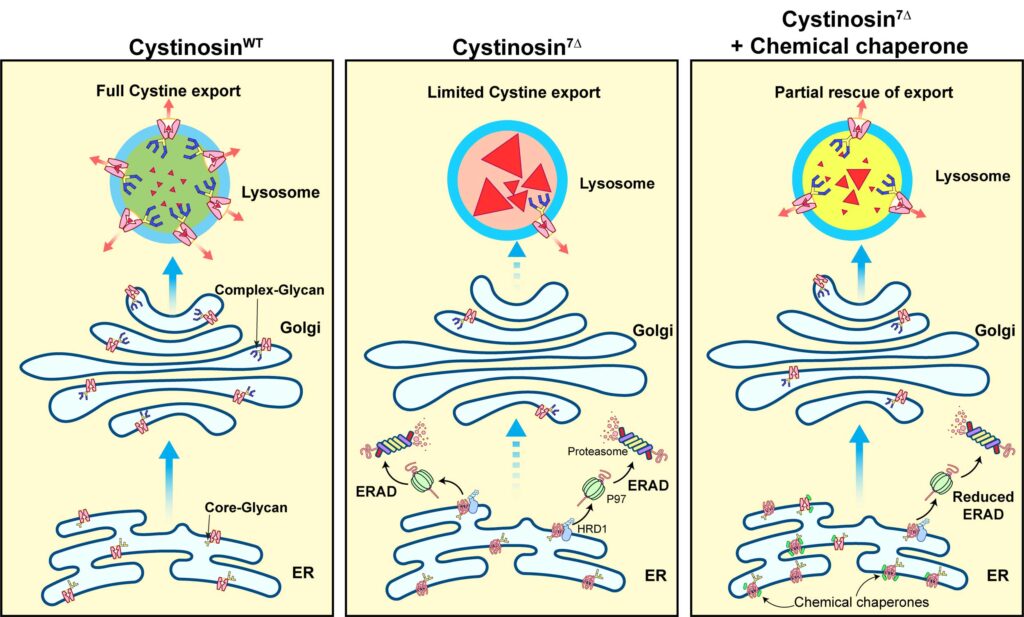 In a healthy lysosome, transporter proteins are able to move cystine, an amino acid, out of the organelle (left). In a patient afflicted with cystinosis, mutated cystine transporters are degraded by a cellular mechanism that degrades damaged proteins, called endoplasmic-reticulum-associated degradation. Consequently, the lysosome is unable to remove amino acid from the organelle, causing a build-up of cystine (center). Using a chemical chaperone also used to treat a form of cystic fibrosis, University of Michigan researchers were able to protect the mutated lysosome cystine transporter from degradation (right).  The chemical chaperones aided in clearing cystine from the lysosome. Image credit: U-M Ming Lab